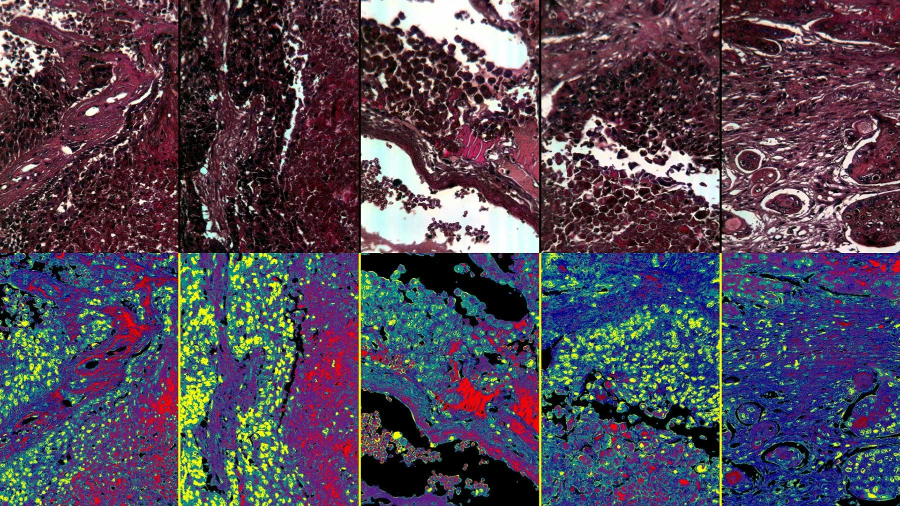 hyperspectral imaging digital pathology cancer cells detection imec